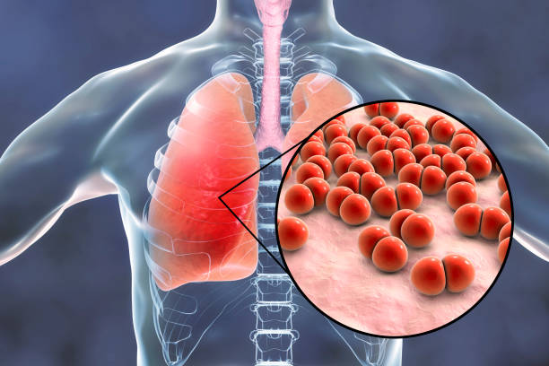 Pneumonia and Meningitis